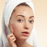 The Trouble with Acne: Things You Need to Know